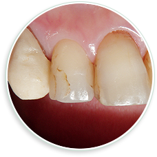 虫歯治療の症例01