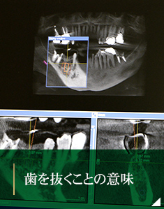 歯を抜くことの意味